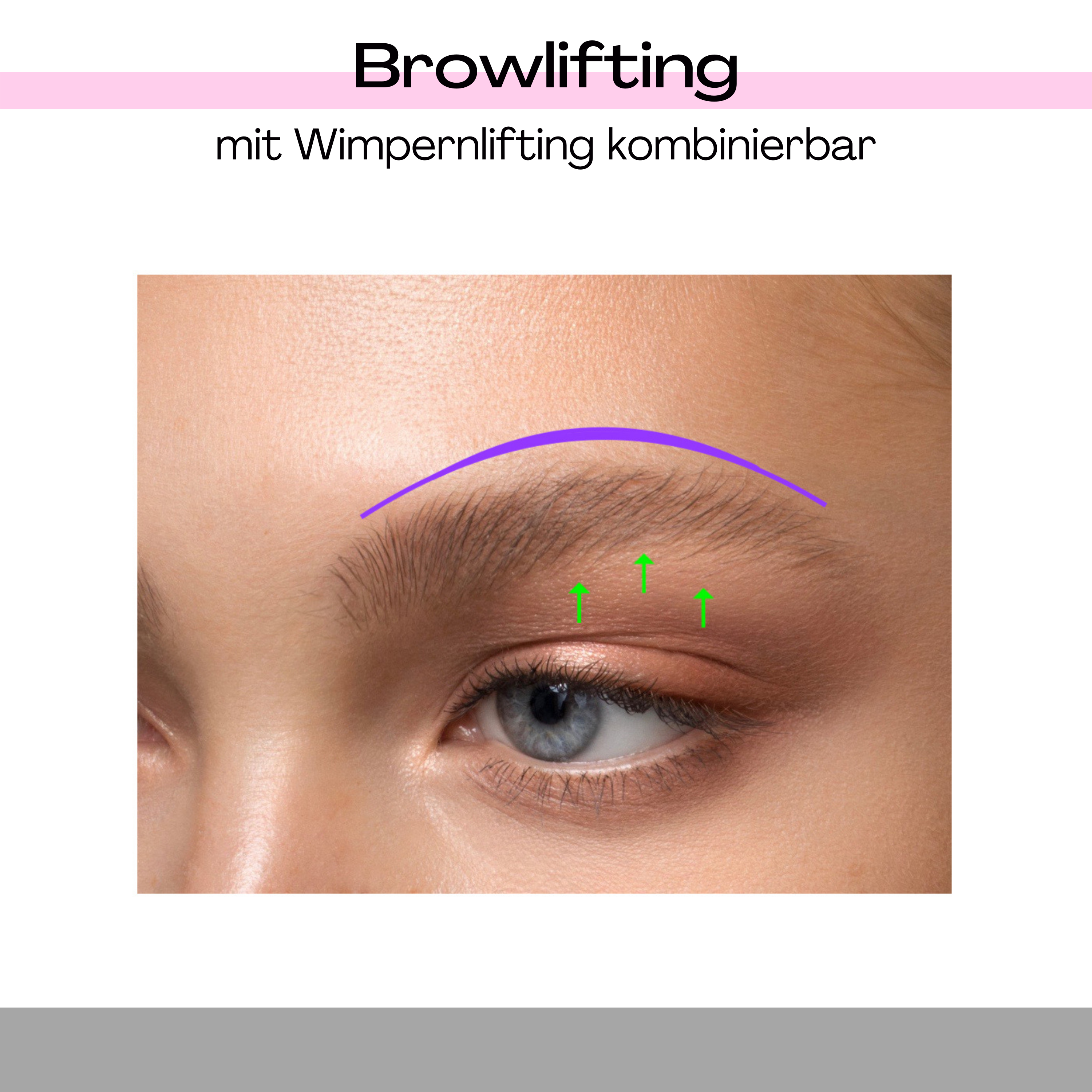 Brow Lifting