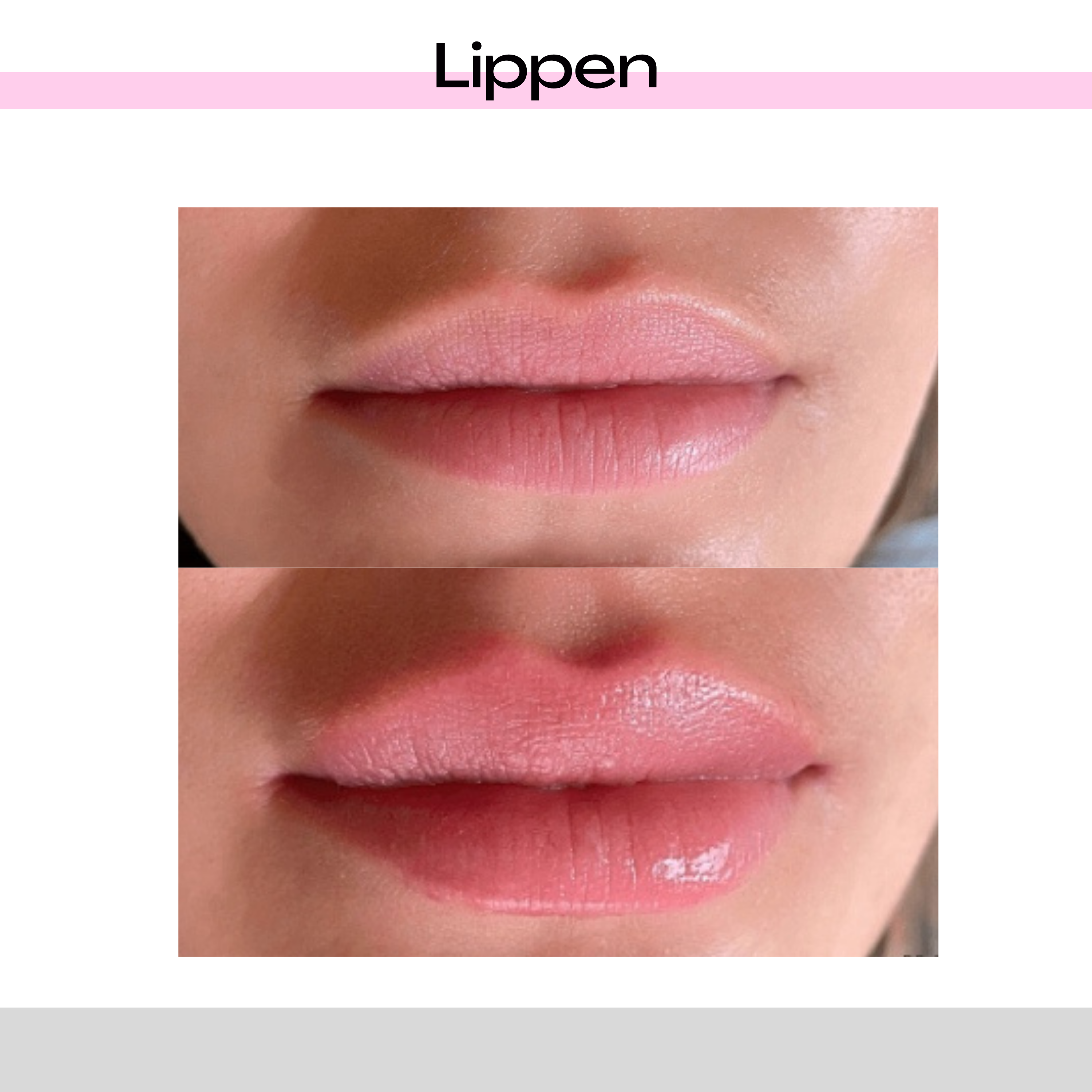 Lippen aufspritzen