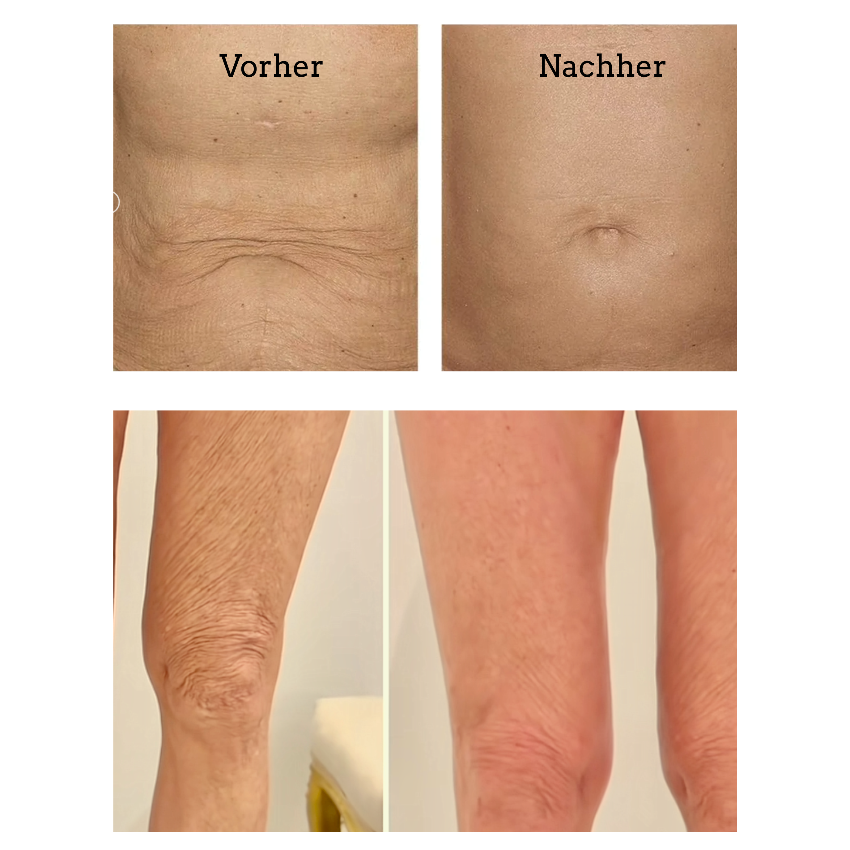 Dehnungsstreifen entfernen, Narben entfernen,